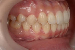 開咬・オープンバイト 治療後右側
