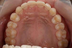 開咬・オープンバイト 治療後上顎咬合面