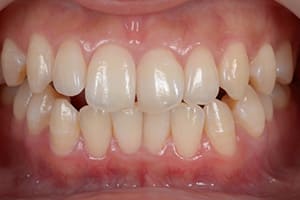 開咬・オープンバイト 治療前正面