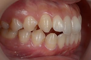 開咬・オープンバイト 治療前右側