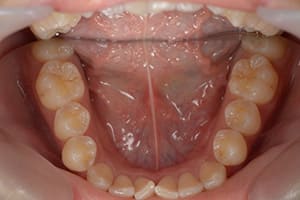 開咬・オープンバイト 治療前下顎咬合面