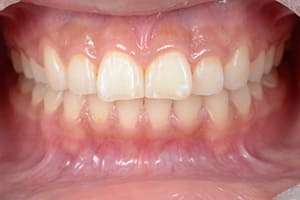 上顎前突・出っ歯 治療後正面