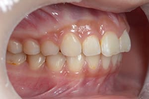 上顎前突・出っ歯 治療後右側