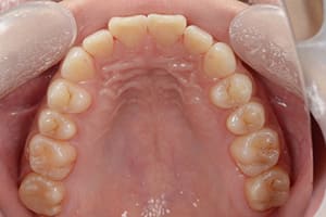 上顎前突・出っ歯 治療後上顎咬合面