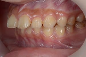 上顎前突・出っ歯 治療前左側