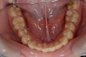 上顎前突・出っ歯 治療前下顎咬合面