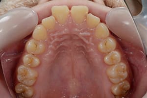 上顎前突・出っ歯 治療前上顎咬合面