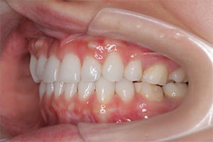 出っ歯・上顎前突 治療後左側