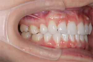 出っ歯・上顎前突 治療後右側