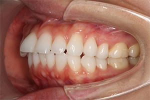 出っ歯・上顎前突 治療前左側