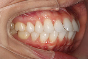 出っ歯・上顎前突 治療前右側