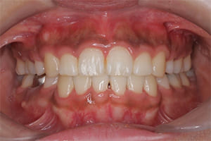 叢生・乱杭歯 治療後正面