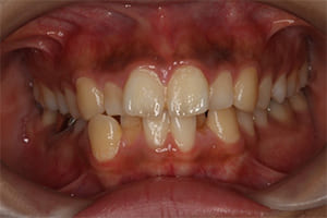 叢生・乱杭歯 治療前正面