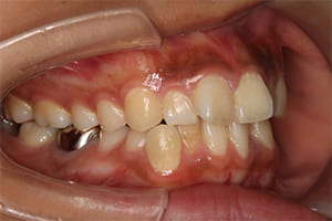 叢生・乱杭歯 治療前右側