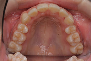 叢生・乱杭歯・八重歯 治療後 上顎咬合面