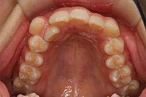 叢生・乱杭歯・八重歯 治療前 上顎咬合面