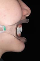 出っ歯・上顎前突.03 治療後 側方面