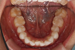 出っ歯・上顎前突.03 治療前 下顎咬合面