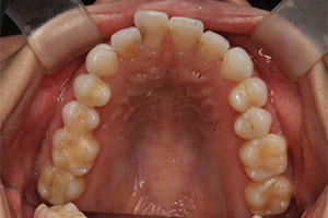 出っ歯・上顎前突.03 治療前 上顎咬合面