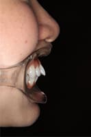 出っ歯・上顎前突.03 治療前 側方面