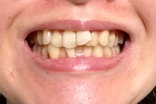 歯並びが悪いとどうなる？