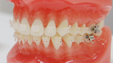 ゴムメタル矯正