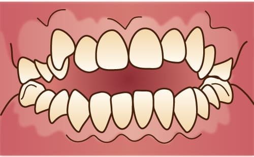 開咬・オープンバイト