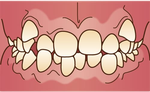 叢生・乱杭歯・八重歯