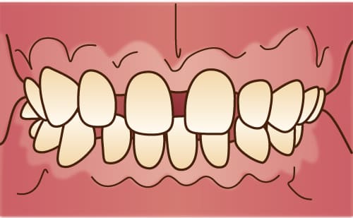すきっ歯（空隙歯列弓）