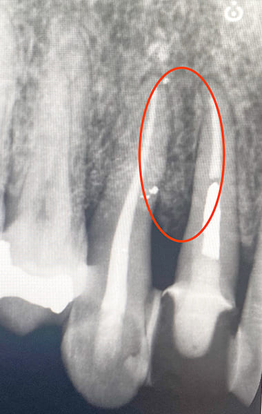 歯周組織再生療法 治療後