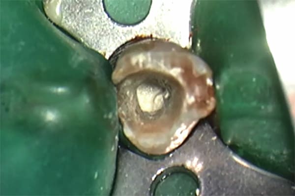 ラバーダム防湿が必要な理由