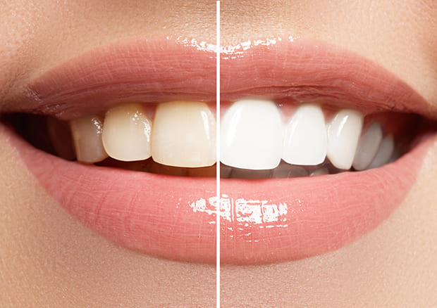 歯の白さが「第一印象」をアップさせます！